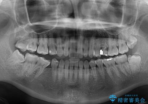 隙間の空いた歯列とボロボロの乳歯 インプラント治療と矯正治療の治療前