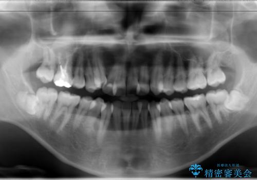 ガタガタの歯並び、八重歯をなおしたい、骨格性下顎前突 カモフラージュ矯正の治療前