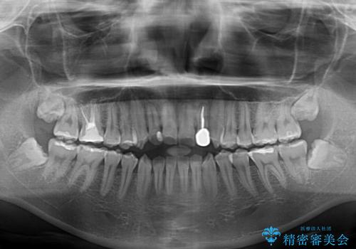 開咬を治す インビザラインによる矯正治療の治療前