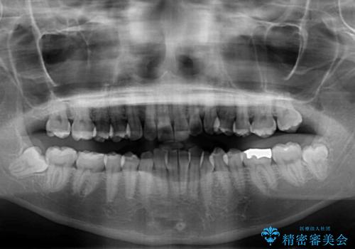【モニター】前歯のデコボコとクロスバイト インビザラインによる矯正治療の治療前