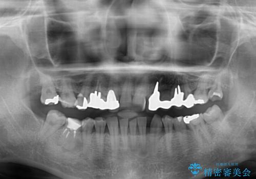 割れてしまった歯が痛む 矯正とインプラントを併用した総合歯科治療の治療前