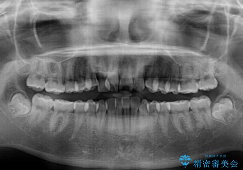 前歯のデコボコとクロスバイトを治したい ワイヤー装置による抜歯矯正の治療前
