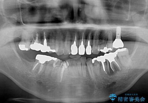 目立つ金属をすべてセラミックに 全顎的メタルフリー治療の治療前