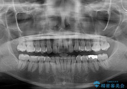 【モニター】前歯のデコボコとクロスバイト インビザラインによる矯正治療の治療後