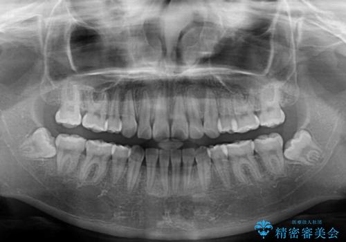 前歯のデコボコとクロスバイトを治したい ワイヤー装置による抜歯矯正の治療後