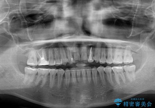 開咬を治す インビザラインによる矯正治療の治療後