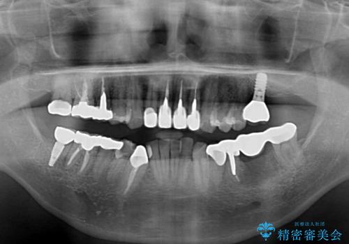 目立つ金属をすべてセラミックに 全顎的メタルフリー治療の治療後