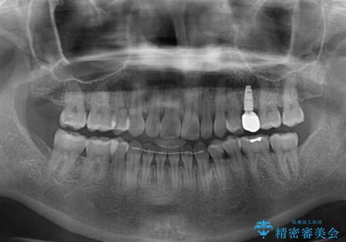 隙間の空いた歯列とボロボロの乳歯 インプラント治療と矯正治療の治療後
