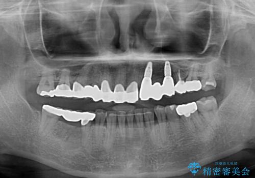割れてしまった歯が痛む　矯正とインプラントを併用した総合歯科治療の治療後