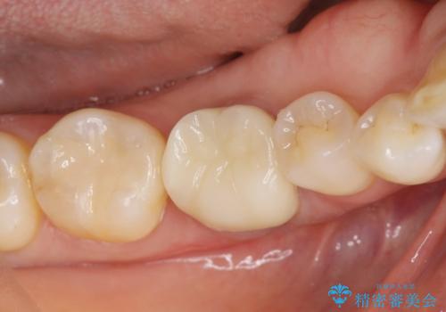 [ 金属アレルギー ] 銀歯を除去するメタルフリー治療の治療後