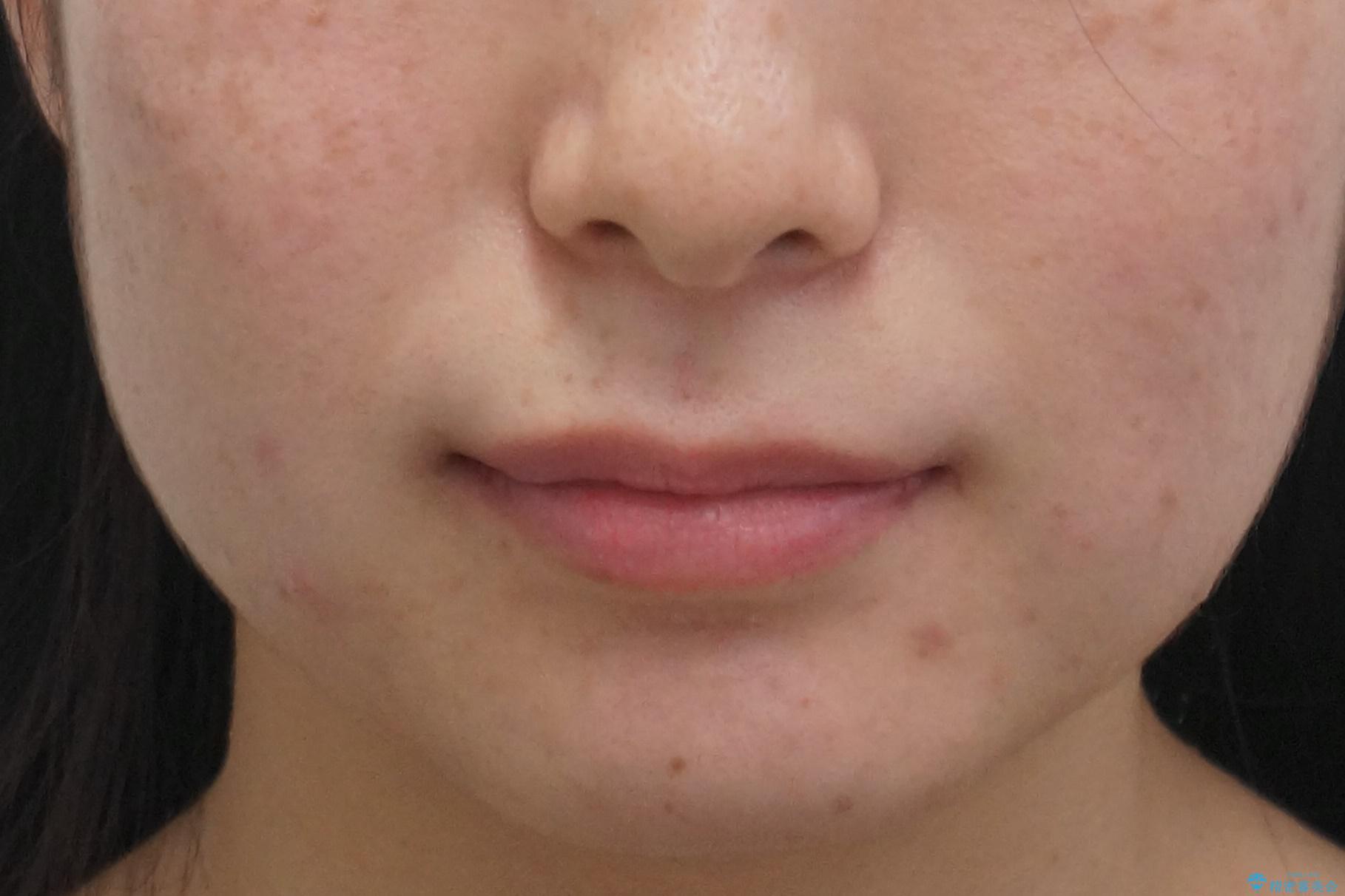 前歯のがたつき、八重歯 インビザラインで抜歯矯正の治療前(顔貌)