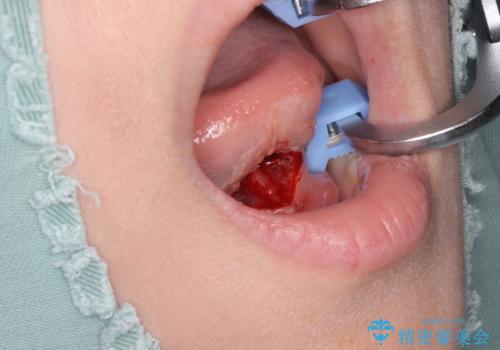 舌が短く話しづらい、滑舌を改善する小手術の治療中