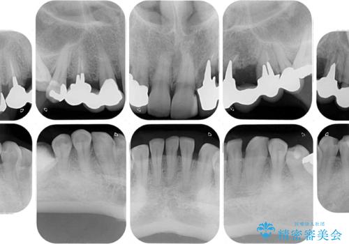 割れてしまった歯が痛む 矯正とインプラントを併用した総合歯科治療の治療前