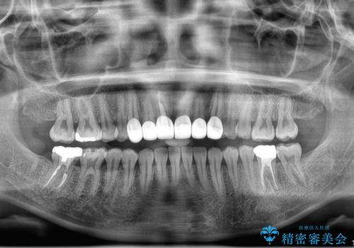 前歯をきれいにしたい、セラミック矯正の治療後