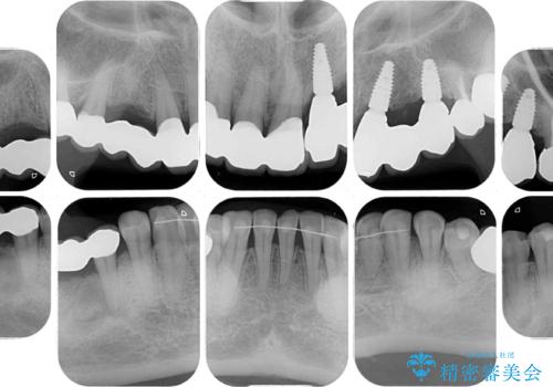 割れてしまった歯が痛む　矯正とインプラントを併用した総合歯科治療の治療後