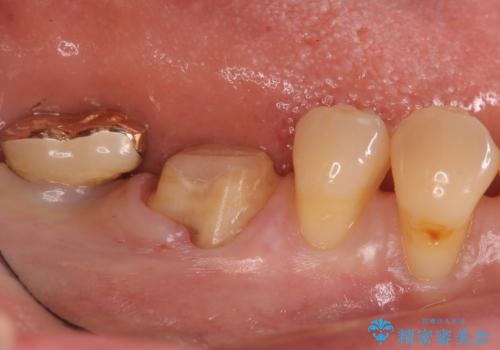 虫歯の治療　できれば歯の向きも変えたいの治療中