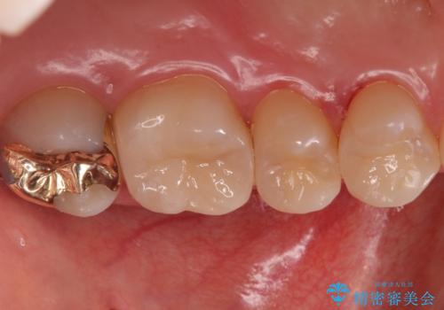 歯と歯の間の虫歯　インレーでの治療(セラミック・ゴールド)の治療後