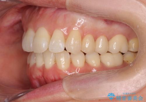 職業柄ワイヤー矯正ができない、マウスピース矯正で行う八重歯抜歯症例の治療後