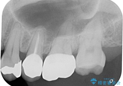 【根管治療・オールセラミッククラウン】何もしなくても歯が痛い 咬むと更に痛いの治療後