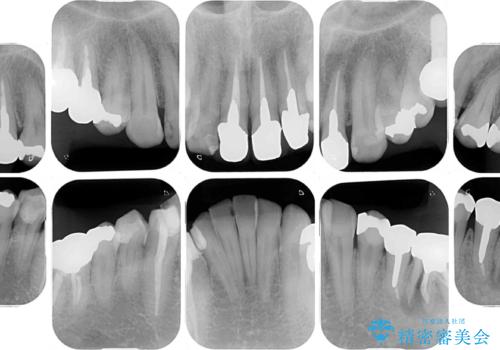 目立つ金属をすべてセラミックに 全顎的メタルフリー治療の治療前