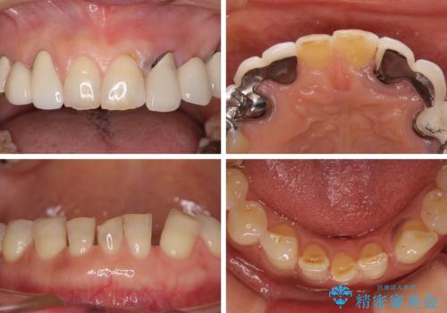 割れてしまった歯が痛む 矯正とインプラントを併用した総合歯科治療の治療前
