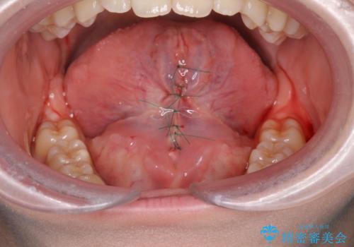 舌が短く話しづらい、滑舌を改善する小手術の治療中