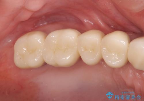 [ 重度の歯周病 ] 骨の造成を伴う奥歯インプラント治療の治療後