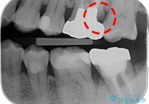 検査で見つかった虫歯 セラミッククラウンでの治療の治療前