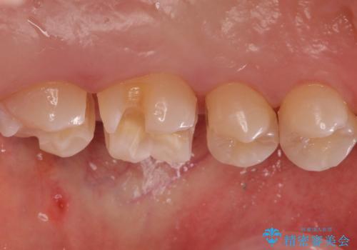 歯と歯の間の虫歯 インレーでの治療(セラミック・ゴールド)の治療中