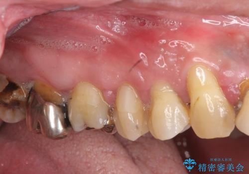 [ 重度の歯周病 ] 骨の造成を伴う奥歯インプラント治療の症例 治療前