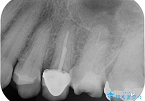 【破折ファイル除去】他院で折れた根管治療の器具をとってほしいの治療前