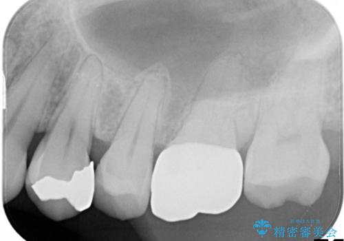 【根管治療・オールセラミッククラウン】何もしなくても歯が痛い 咬むと更に痛いの治療前