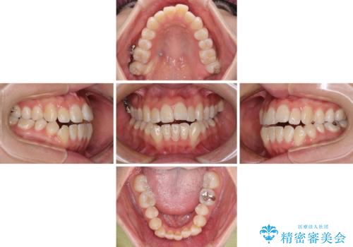 外に飛び出して磨きにくい奥歯と上下前歯の隙間　インビザラインによる矯正治療の治療中