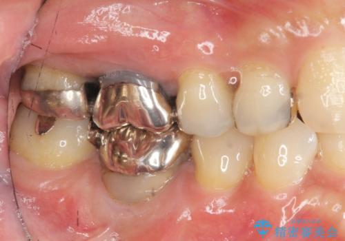 [ 金属アレルギー ] 銀歯を除去するメタルフリー治療の症例 治療前