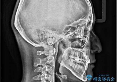 ガタガタの歯並び、八重歯をなおしたい、骨格性下顎前突 カモフラージュ矯正の治療後