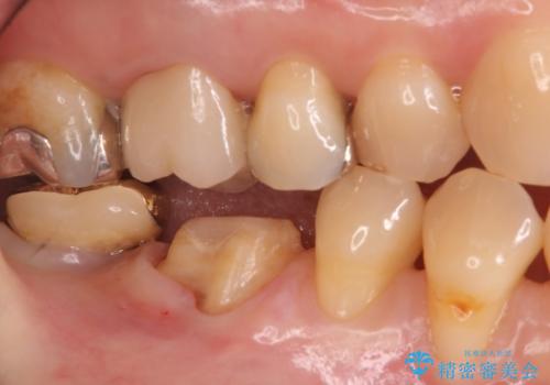 虫歯の治療 できれば歯の向きも変えたいの治療中