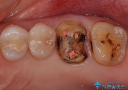 検査で見つかった虫歯 セラミッククラウンでの治療の治療中