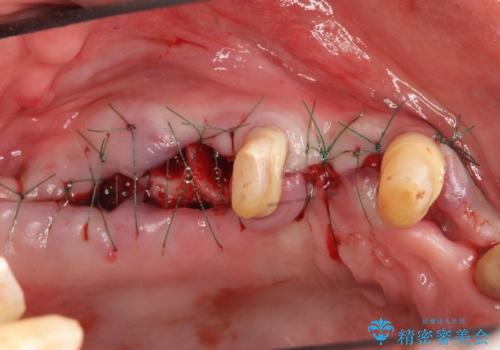 [ 重度の歯周病 ] 骨の造成を伴う奥歯インプラント治療の治療前