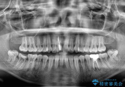 前歯をきれいにしたい、セラミック矯正の治療前