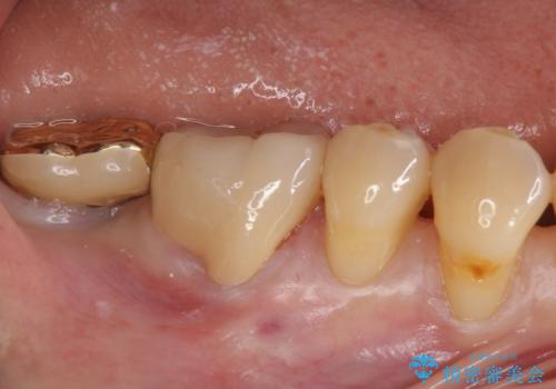 虫歯の治療 できれば歯の向きも変えたいの治療後