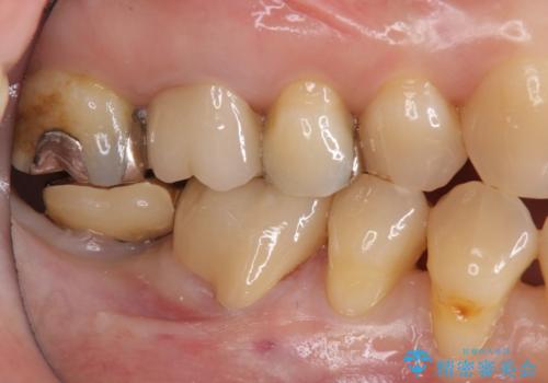 虫歯の治療 できれば歯の向きも変えたいの治療後