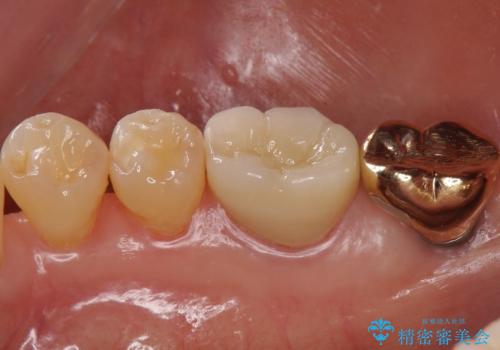 虫歯の治療 できれば歯の向きも変えたいの治療後