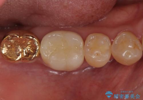 虫歯の治療　できれば歯の向きも変えたいの症例 治療後