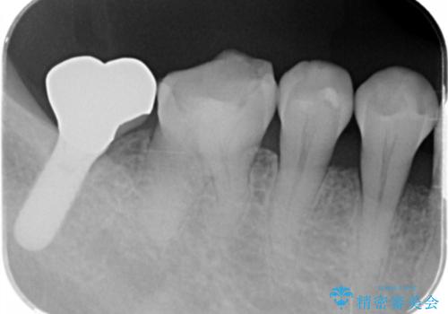 虫歯の治療 できれば歯の向きも変えたいの治療前