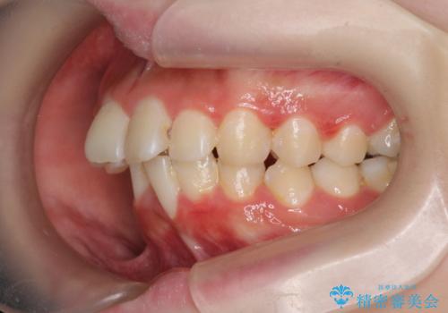 [ 出っ歯を治したい ]　マイクロインプラントを用いた大きな後方移動の治療前