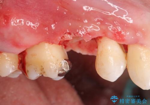 強い咬合力クリアランスの問題を解決したメタルボンドブリッジ治療の治療前