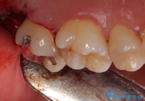 歯ぐきの形を整え、外れにくい被せ物を装着の治療中
