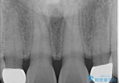 歯の形気になる!! セラミック治療 前歯( エクセレント)の治療後