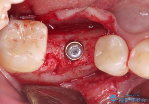 失った歯のインプラント補綴の治療中