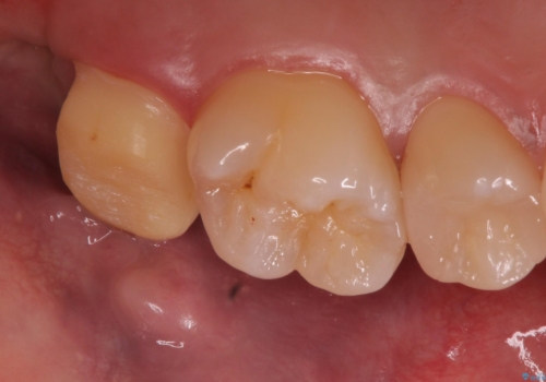 歯ぐきの形を整え、外れにくい被せ物を装着の治療中